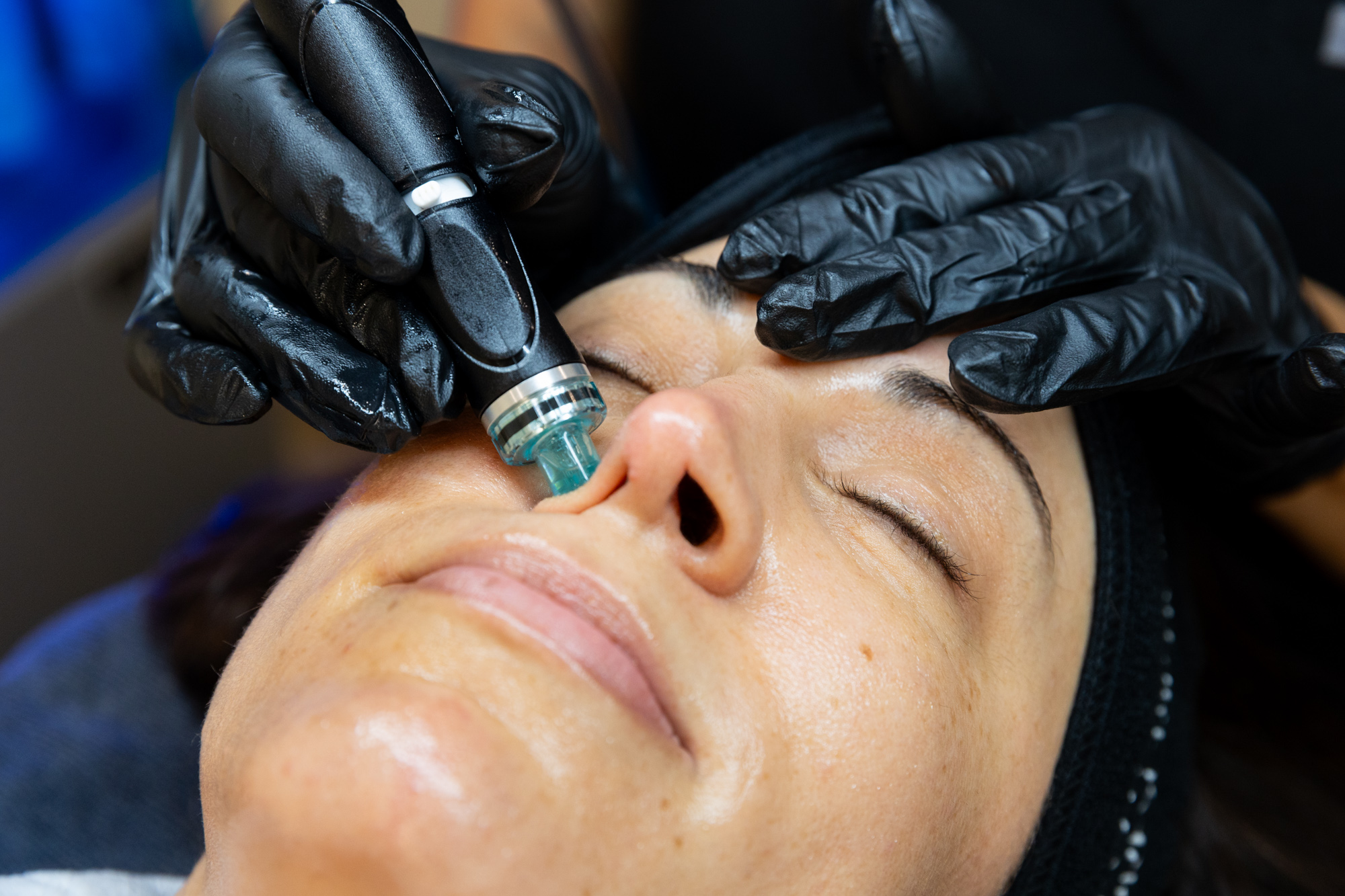 Close up of a HydraFacial treatment on a woman near Pittsburgh