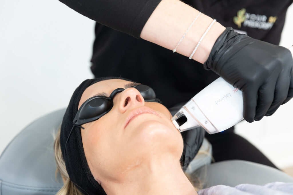 Close up of a woman receiving Laser Skin Resurfacing near Pittsburgh
